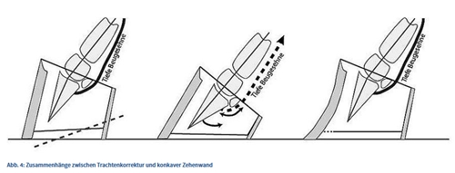 Grafik - Dr. K. Rasch: Zusammenhänge zwischen Trachtenkorrektur und konkaver Zehenwand